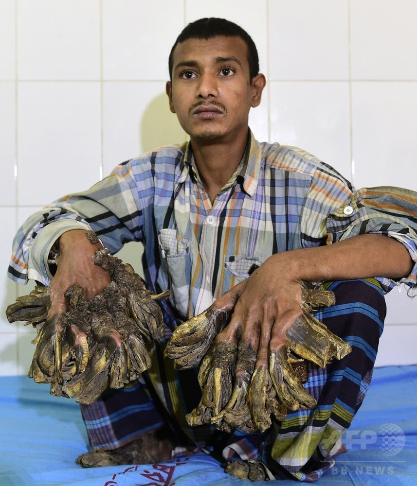 バングラデシュの 樹木男 巨大イボ除去手術へ 写真6枚 国際ニュース Afpbb News