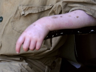 15歳のアルビノ少年、切断遺体で見つかる ブルンジ