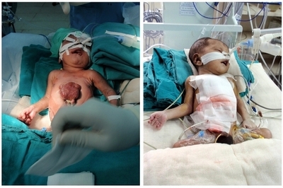 心臓逸脱症の赤ちゃんが死亡 インド