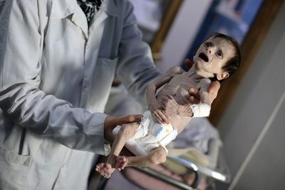シリアの封鎖地域で、餓死する子どもたち