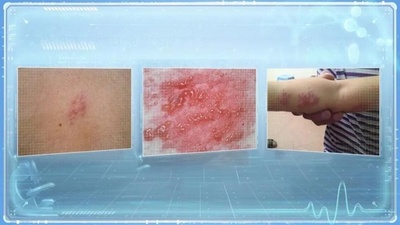 宅配便を受け取った中国の女性 目をこすったことで帯状疱疹に