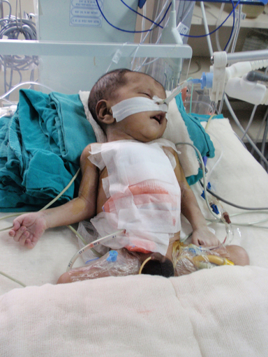 心臓逸脱症の赤ちゃん、心臓埋め込み手術に成功 インド