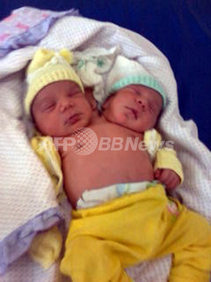 頭が2つ 体は1つ ブラジルで結合双生児が誕生 写真2枚 ファッション ニュースならmode Press Powered By Afpbb News