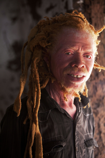 国にはびこる偏見をなくせ、アルビノのサッカーチーム タンザニア