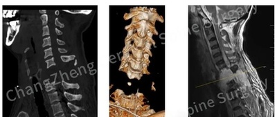 上海の医学チーム ほぼ「首が胴体から切り離されたような状態」の患者の頚椎固定手術に成功