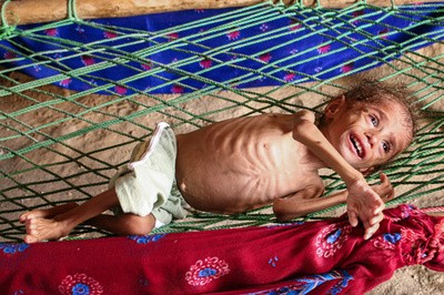 【写真特集】内戦続くイエメン、栄養失調に苦しむ子どもたち