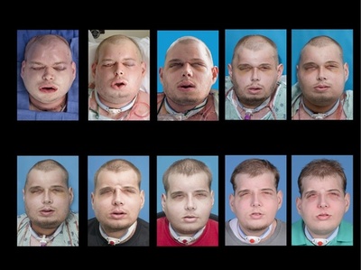 史上最も複雑な顔面移植手術、消防団員の男性に実施 米病院