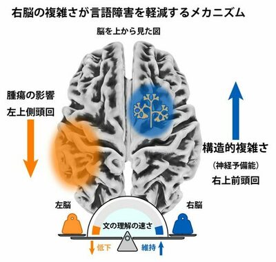 【昭和医科大学】左脳の脳腫瘍による言語障害の個人差を解明 ― 右半球の「構造的複雑さ」が言語処理速度を維持する予備能として機能する可能性を示唆 ―