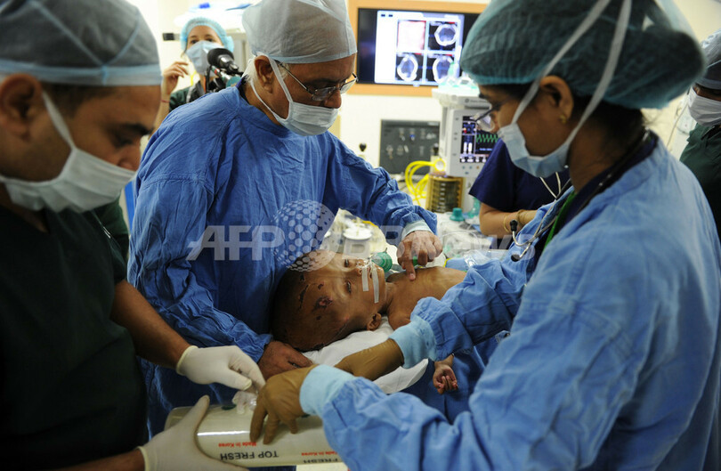 水頭症のルーナちゃん、手術は「完璧」に成功 インド