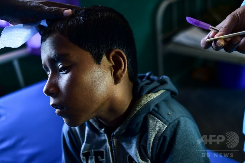 ジフテリア、ロヒンギャ難民キャンプで猛威 世界的にはまれな疾患に