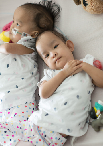 ブータンの結合双生児、分離手術から6日たつも「常に一緒」