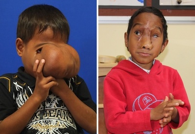 少年の顔から巨大ヘルニア嚢を除去、オーストラリア