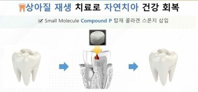 歯の治療、あの「耳障りな音」はもうおしまい…韓国スタートアップが「自然歯」作る革新治療