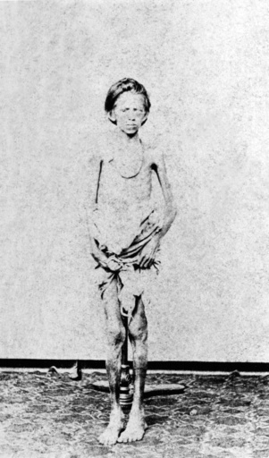 「やせ細った少年」