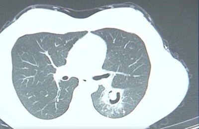 女性が高熱3日続く 原因は1か月前のクローゼットの片付け 中国