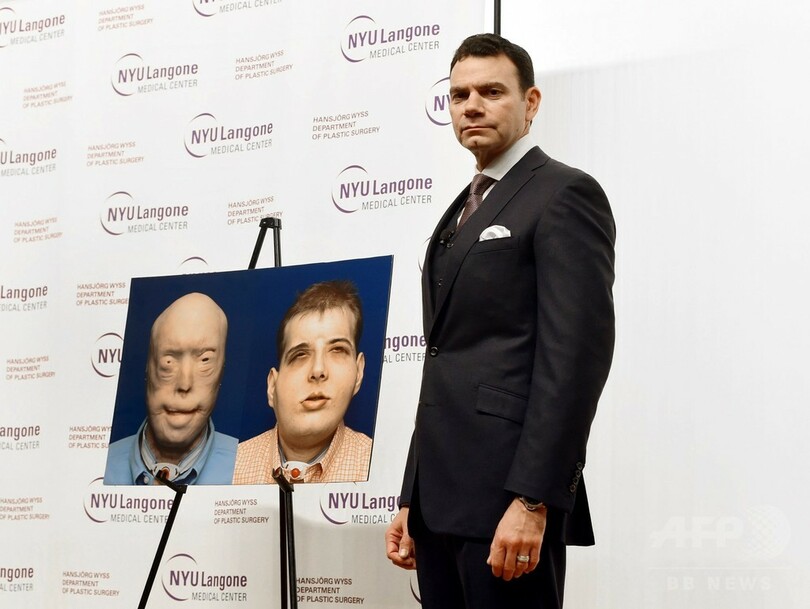 史上最も複雑な顔面移植手術、消防団員の男性に実施 米病院