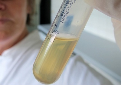 「糞便バンク」開設、腸内感染症治療に活用 オランダ