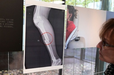 DV被害者のX線写真展示、医師「真実示したい」 伊ミラノ