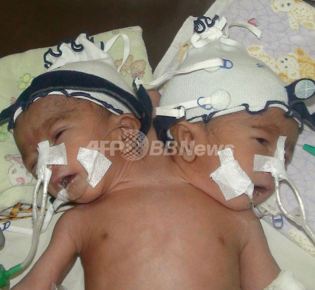 結合双生児、生後5日で死亡 インドネシア 写真2枚 国際ニュース:AFPBB News