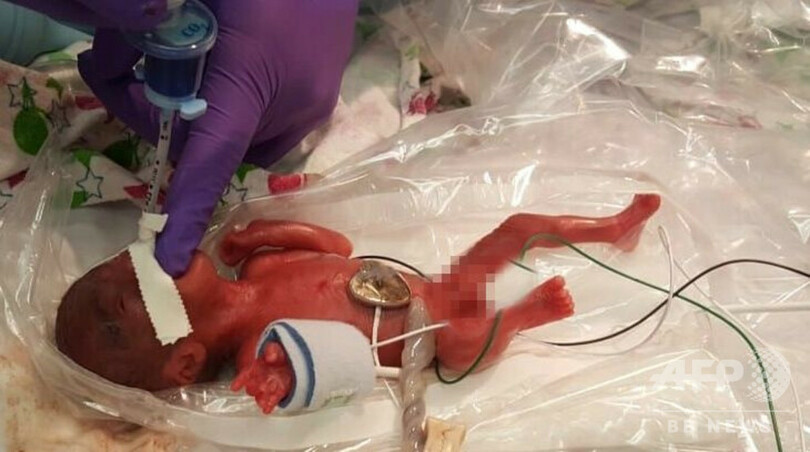 世界最小、245グラムで生まれた赤ちゃん 元気に退院 米カリフォルニア 写真5枚 国際ニュース：AFPBB News