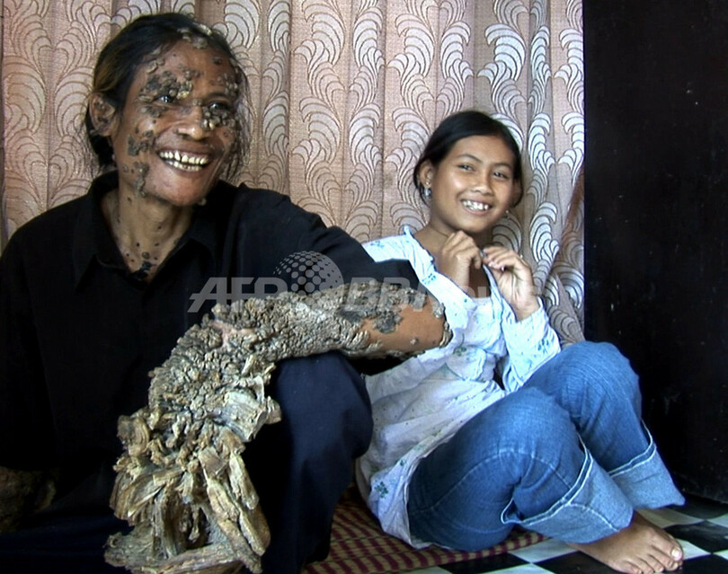 インドネシアの 樹木男 米国での治療に暗雲 写真3枚 国際ニュース Afpbb News