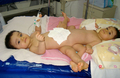 ブラジル・ゴイアニア（Goiania）の病院で分離手術を待つ結合双生児のイスラエル（Israel）ちゃんとレビ（Levi）ちゃん（2012年2月14日撮影）。(c)AFP/Dr Zacharias Calil