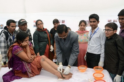 皮膚に生きた蛭這わせる「ヒル療法」、インドで人気