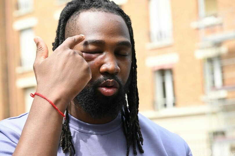 警察拘束下で死亡した男性の弟、追悼デモで拘束され負傷 仏