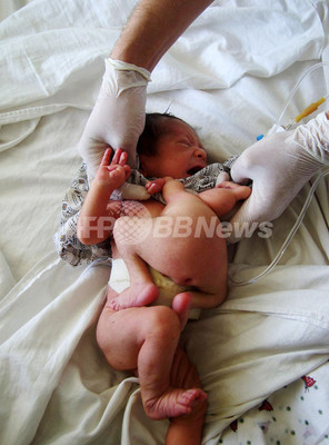 アフガニスタンで結合双生児が誕生 頭部のない1人は死亡 写真1枚 ファッション ニュースならmode Press Powered By Afpbb News
