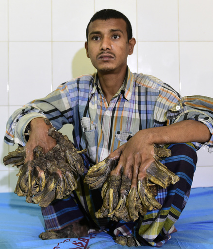 写真特集】世界各地で報告されている「難病・奇病」 写真19枚