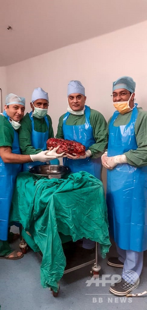 7.4キロの腎臓、インドの難病患者から摘出 過去最大級
