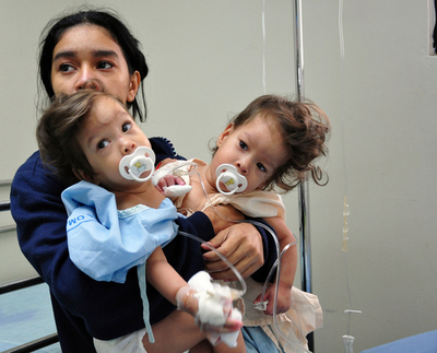 パナマ初、結合双生児の分離手術