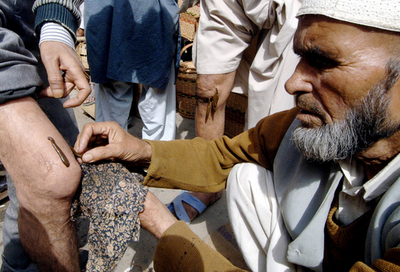 インドで伝統的なヒル療法が人気