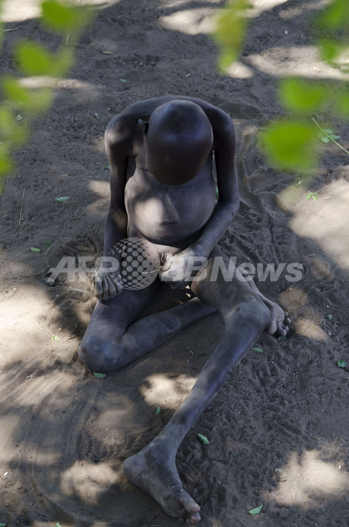 ウガンダの子供たちを襲う謎の奇病「うなずき病」、原因も治療法も不明