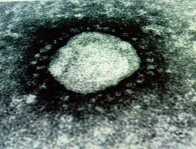 SARSに似たウイルス感染症の患者が死亡、英病院が発表