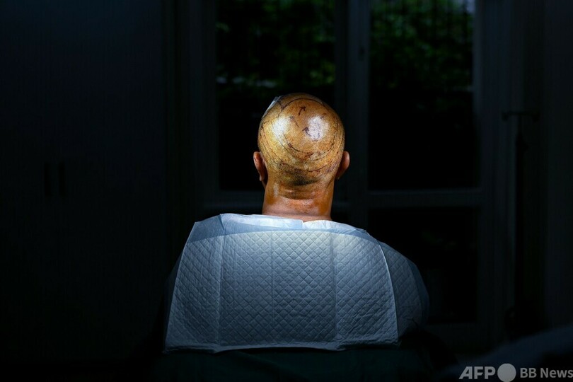 植毛手術後に死亡、YouTubeで独学の素人施術が横行 インド