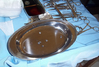 104発撃たれたオランウータン、奇跡的に生き延びる インドネシア