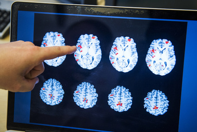 統合失調症患者の幻聴、脳への磁気刺激で改善 研究