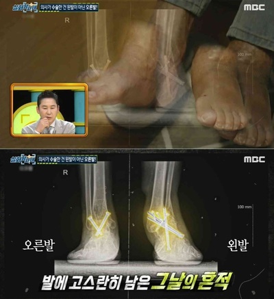 痛い足でなく、正常な足の骨切った韓国の有名病院…「メディアに知らせたらお互い困る」