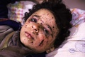シリアの首都ダマスカス近郊の反体制派支配地区、東グータに対する空爆で負傷し、地区内の仮設の病院で治療を受ける少年（2018年2月25日撮影）。(c)AFP PHOTO / AMER ALMOHIBANY