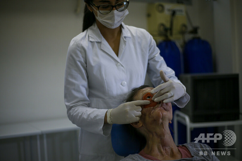 顔面欠損の患者、安価な「新たな顔」を3Dプリンターで手に ブラジル