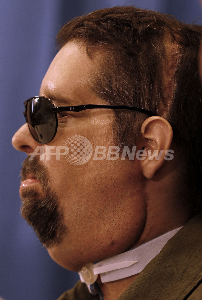 米国初の全顔面移植の男性、新しい顔で会見