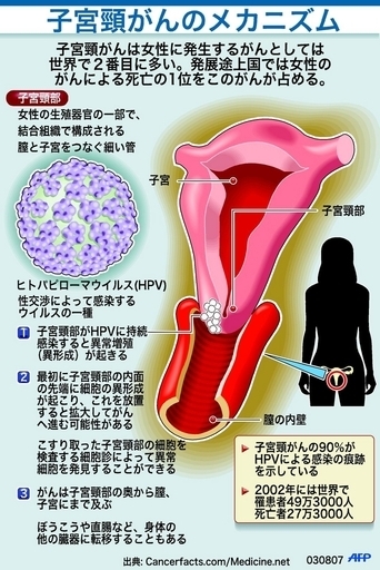 発展途上国の女性を脅かす、子宮頸がんのメカニズム