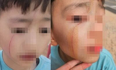 “凶器”は鉛筆、上級生に顔を引っ掻かれた「痛々しい」児童の顔…韓国・保護者「校内暴力だ」