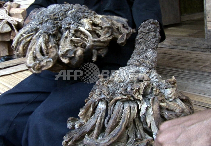 インドネシアの「樹木男」、米国での治療に暗雲