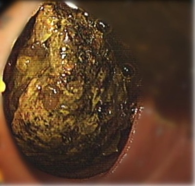 50歳男性が干し柿を一度に10個も食べ十二指腸に穴の危険 中国