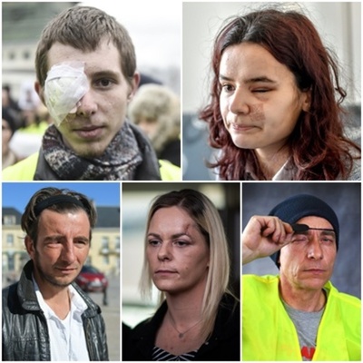 黄ベスト運動で片目失った人々に独自取材、治安当局のゴム弾などで負傷