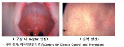 「今、旅行しても大丈夫？」…世界で流行中の「はしか」、韓国でも予防の徹底呼びかけ