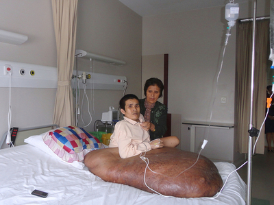 90キロの腫瘍ができたベトナム人男性、切除手術に臨む