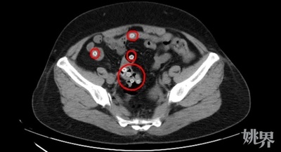 中国、女性がヤマモモ食べて腹痛 病院へ